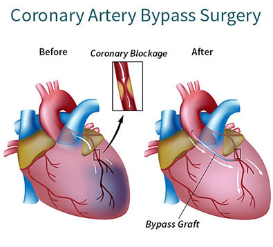 Coronary-Artery-Bypass-Graft-Surgery