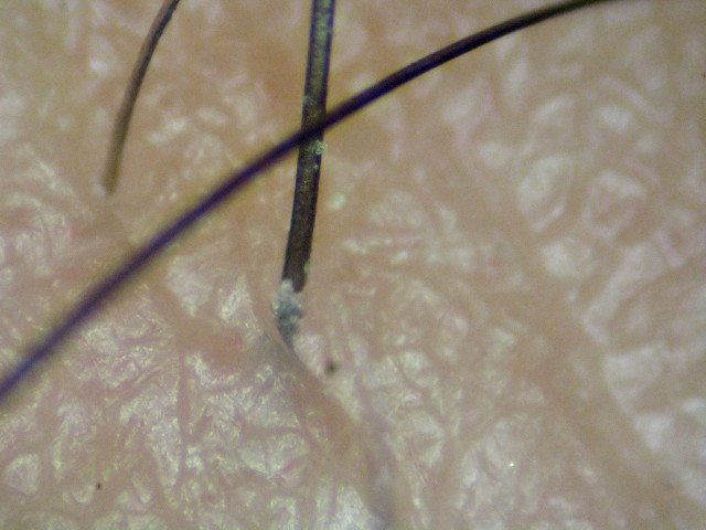 clogged hair follicles