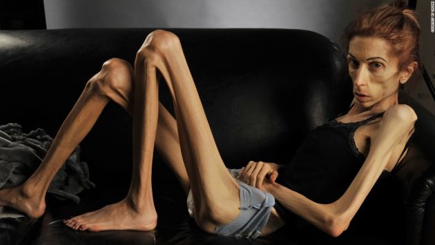 Anorexia Nervosa Is An Eating Disorder