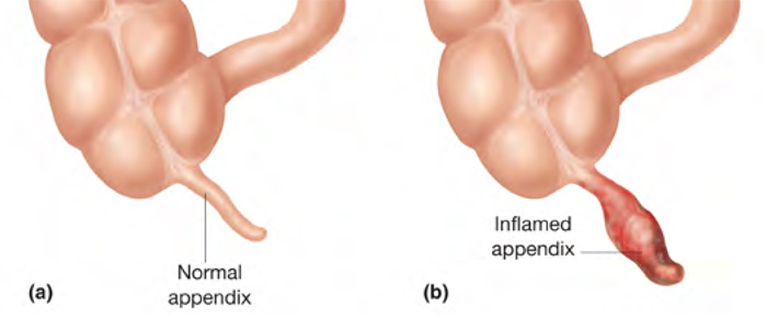 appendix-pain-2