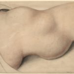 Charcot Joint
