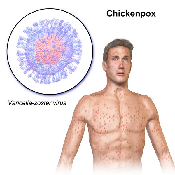 chickenpox