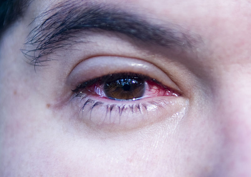 Perennial Conjunctivitis