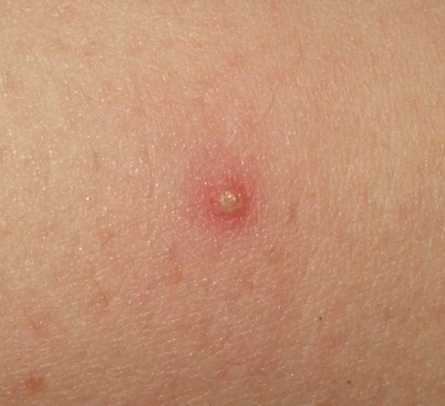 How is Folliculitis Diagnosed?