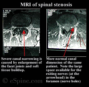 MRI of spinal stenosis