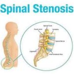 Spinal Stenosis
