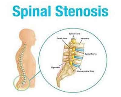 Spinal Stenosis