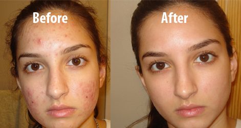 baking-soda-for-face-before-and-after