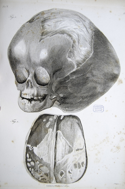 Congenital Hydrocephalus treatment