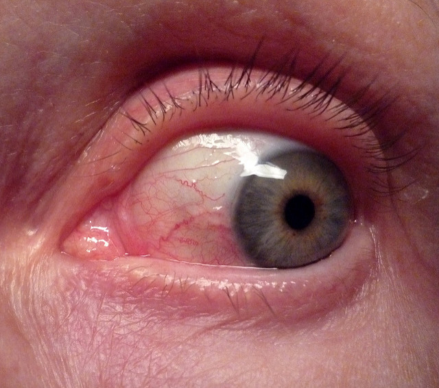 Conjunctivitis