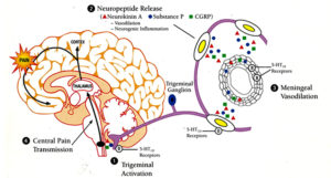 79-four-stages-of-a-migraine