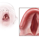 Goldenhar Syndrome