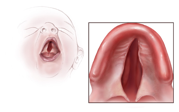 Goldenhar Syndrome