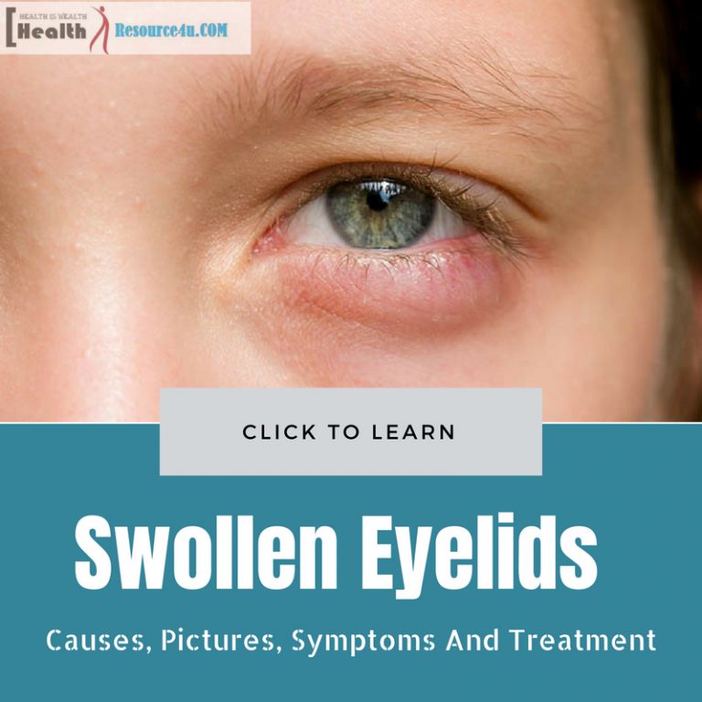 Swollen Eyelids Causes and Treatment