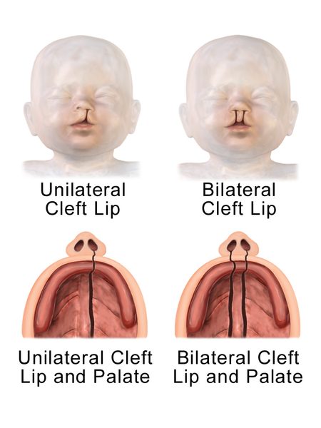 Goldenhar Syndrome symtoms