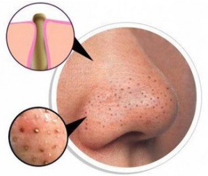 blackheads