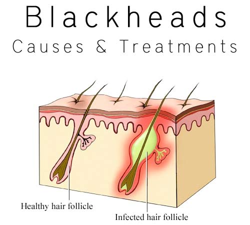 blackheads1