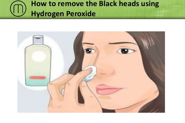 how-to-remove-blackheads-using-hydrogen-peroxide-1-638