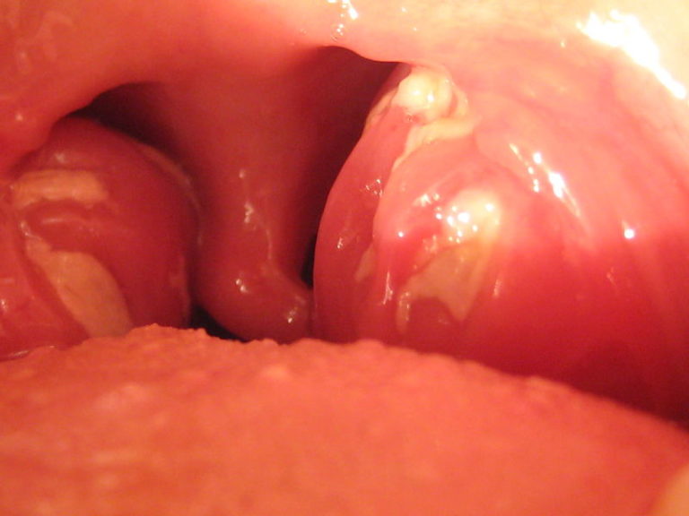 mono tonsils mono tonsils