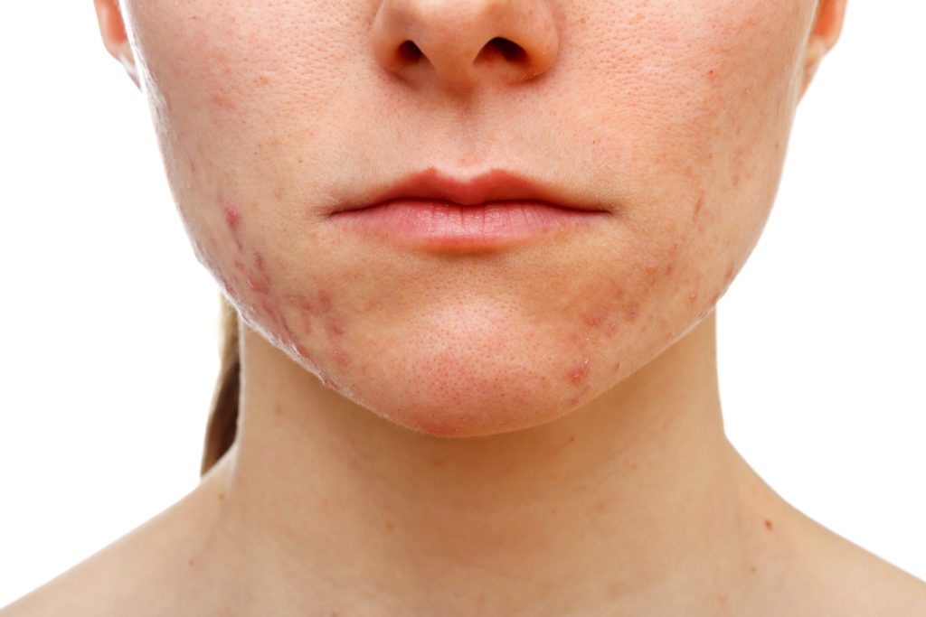 Portrait of young girl with skin problem on isolated white background