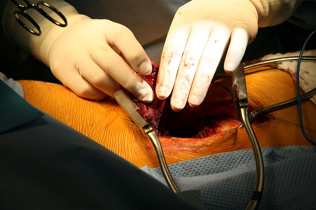 Phlebitis Surgery