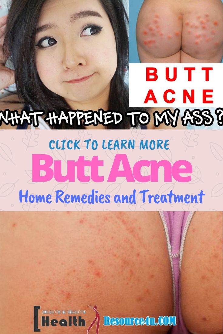 How To Get Rid Of Butt Acne