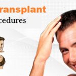 Hair Transplant Procedures