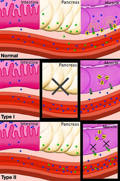 Lack of insulin