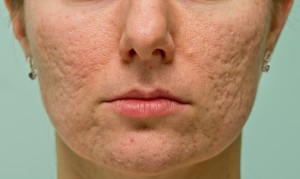 Connection between Acne and Large Pores