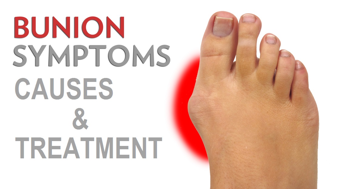 Bunions Causes, Symptoms, and Treatment