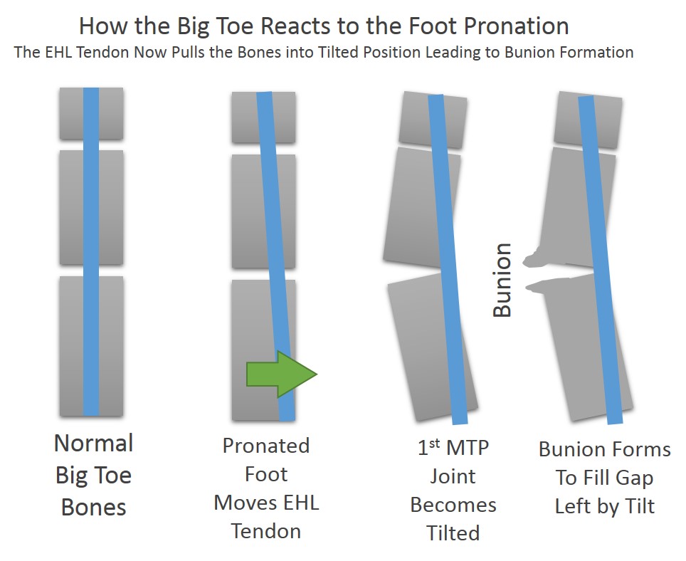 Causes of Bunions