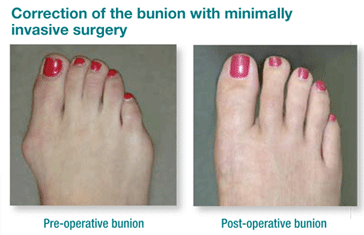 Treatment for Bunions