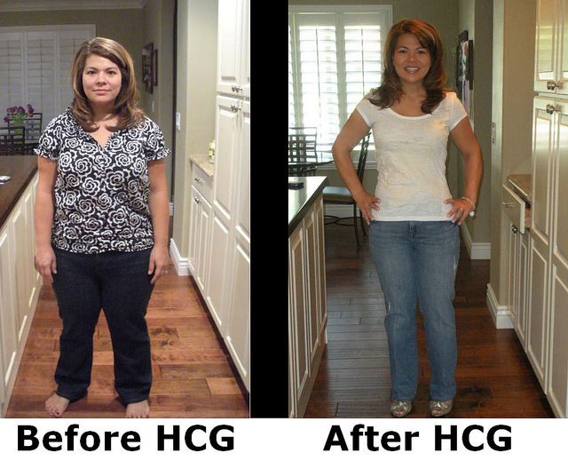 HCG Dieter before and after