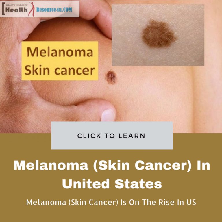 Melanoma (Skin Cancer)