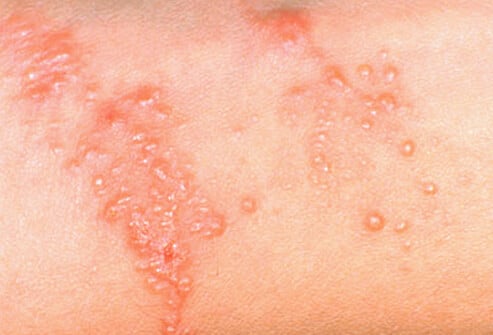 common adult skin problems s8 photo of poison ivy rash
