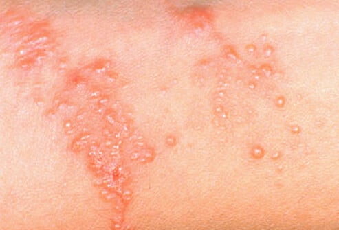 common adult skin problems s8 photo of poison ivy rash