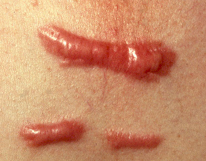 Hypertrophic and keloid Scars