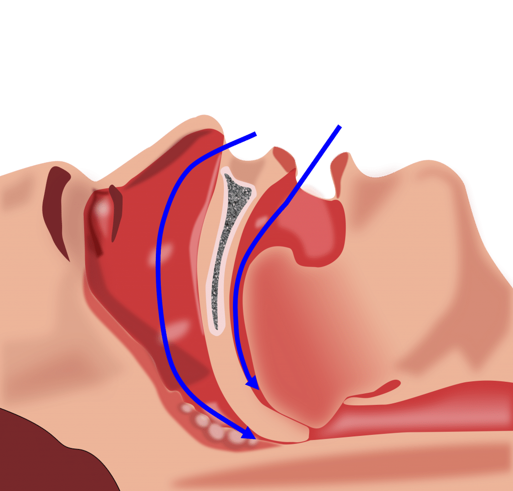 Carry Out nasal Exercises