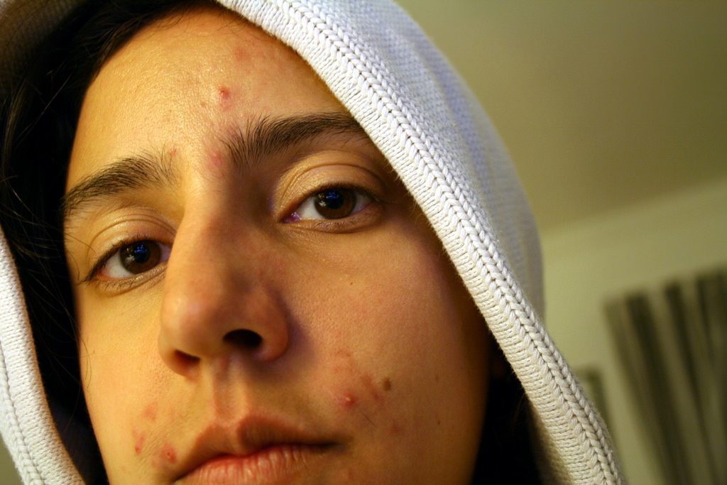 How Acne Can Affect Your Teen's Life