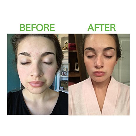 Egg white and honey mask for acne Egg white and honey mask for acne