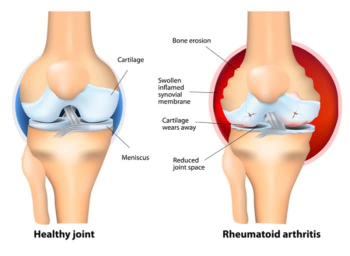 Arthritis Home Care - Helpful Hints & Tips