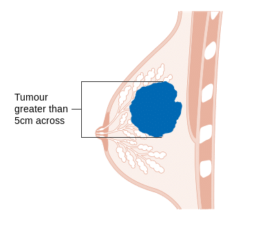 Symptoms of Breast Cancer