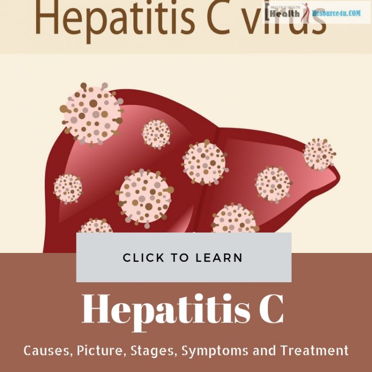 Hepatitis C Causes treatment