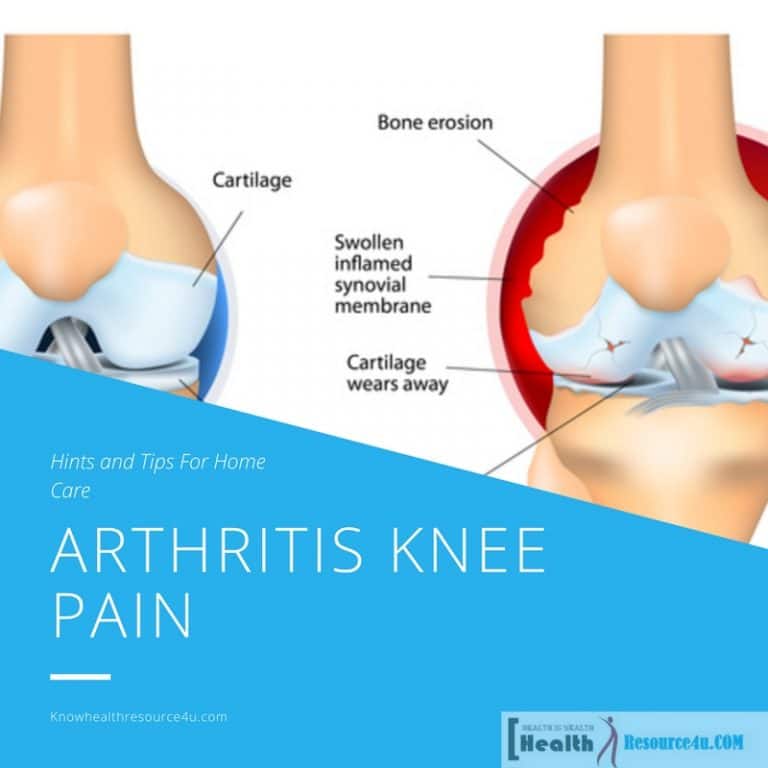 Arthritis Knee Pain