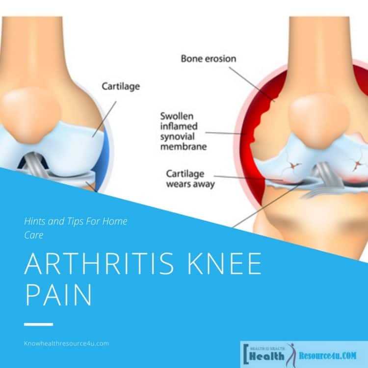 Arthritis Knee Pain e1519874111246