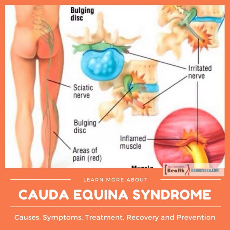 Cauda Equina Syndrome causes and treatment