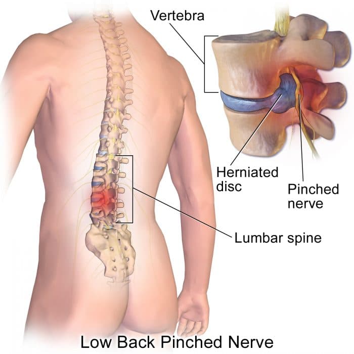 Lumbar Herniated Disc