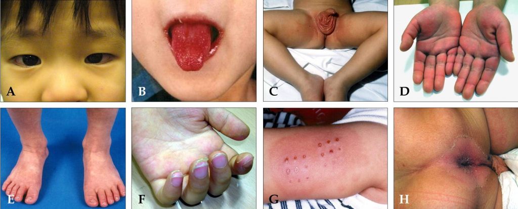 Kawasaki Disease Symptoms