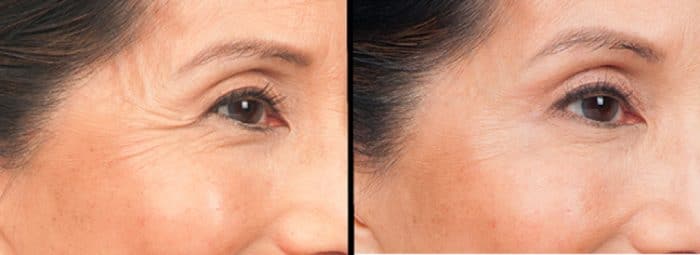 Remove Fine Lines on Skin: