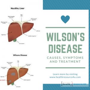 Wilson’s Disease : Causes, Symptoms And Treatment